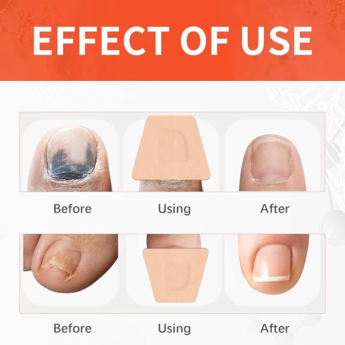 Toe Nail Fungus Treatments,Toenail Fungus Treatment Extra Strength,Fungal Nail Renewal Patches,Medical-Grade Adhesive,Gentle & Effective Nail Renewal Treatment,Strong Adhesion, No Irritation 32Pcs