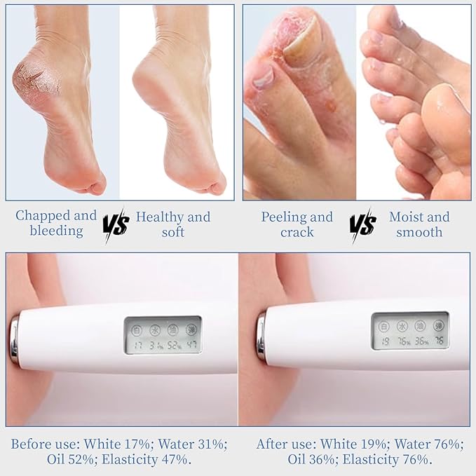 10.1 Oz - Urea Cream 70% plus Salicylic Acid 2% for Dry Cracked Feet, Heels, Knees, Elbows and Hands, Moisturizes, Softens and Removes Calluses Dead Skin