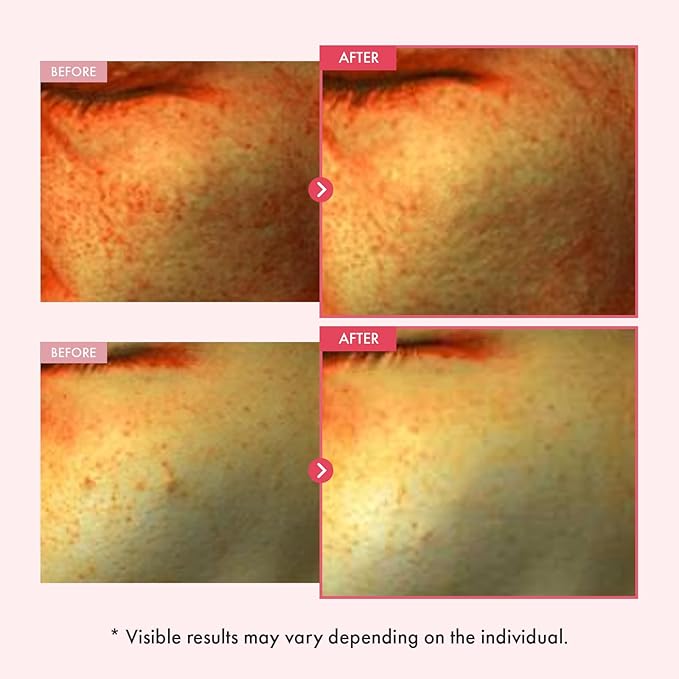 TOSOWOONG Niacinamide 10% Arbutin 7% Serum, Hyperpigmentation, Dark Spot Remover, Discoloration Correcting for Uneven Skin Tone, Glass Skin, All Skin Types, Korean Skincare, 33ml / 1.11 fl. oz.