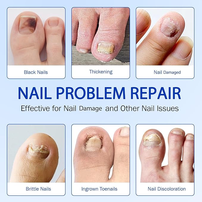 Nail Patches for Toenails, 21pcs/Bag Toenail Extra Strength, Nighttime Nail Repair for Damaged, Discolored Nails, Safe for Sensitive Skin, Easy to Apply (42 PCS)