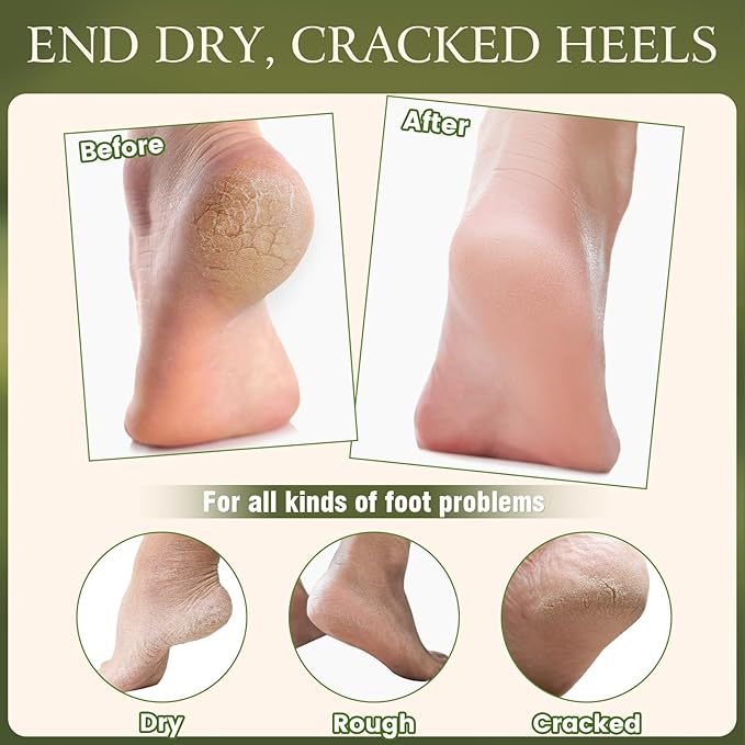 2 Pcs Cracked Heel Treatment & Repair Stick Set (Foot Balms + Heel Socks) – Jojoba Oil Infused cracked heel stick Balm for Dry, Cracked Heels – No-Mess Applicator, Travel-Friendly