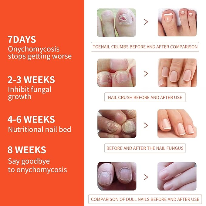 Toe Nail Fungus Treatments,Toenail Fungus Treatment Extra Strength,Fungal Nail Renewal Patches,Medical-Grade Adhesive,Gentle & Effective Nail Renewal Treatment,Strong Adhesion, No Irritation 32Pcs