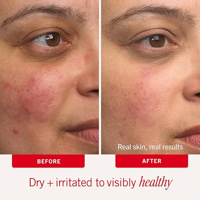 First Aid Beauty - Ultra Repair Cream - Intense Hydration Face & Body Moisturizer - Whipped Colloidal Oatmeal Clinically Proven to Strengthen Skin Barrier in 7 Days - Helps Relieve Eczema, 8 oz